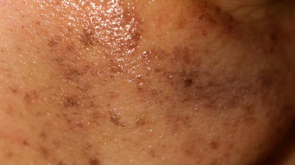 桥本需补硒吗（硒对桥本甲状腺炎的帮助）-硒宝网